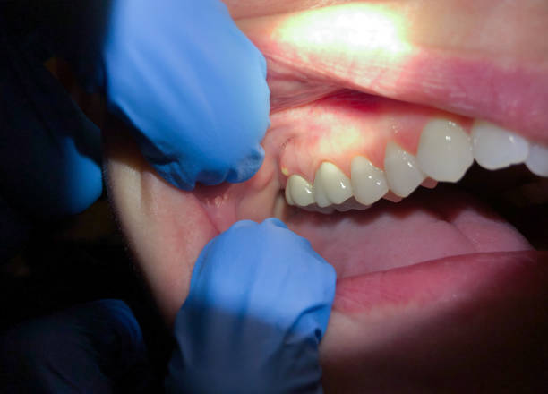 Best Knocked-Out Tooth Emergency  in Penndel, PA